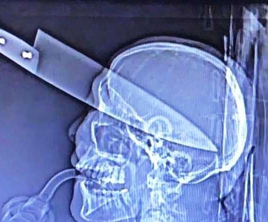 Dourados: homem morre após ter faca cravada no olho