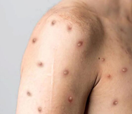 ALERTA: Brasil tem mais de 200 casos confirmados de varíola dos macacos