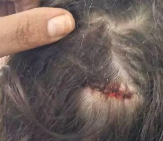 Menina de 7 anos é ferida por bala perdida enquanto dormia em casa
